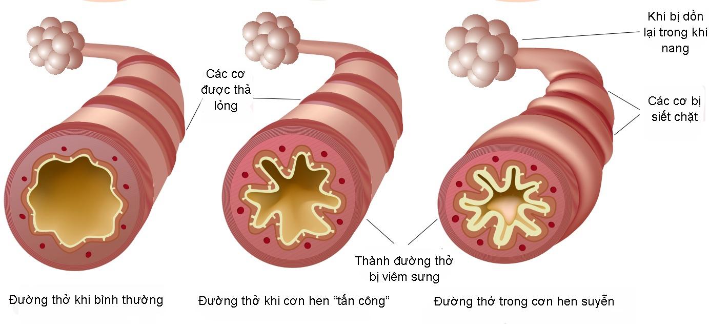 bệnh hen là bệnh gì